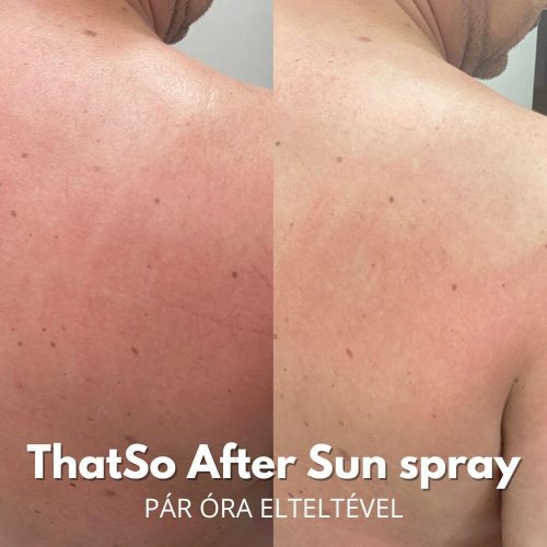 That'so - After sun hidratáló napozás utáni spray - All in One barnulást fokozó bőrnyugtató